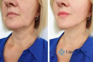 Double chin before and after Hi-Fu treatment 4 Book your double chin treatment England today! We are here to help!