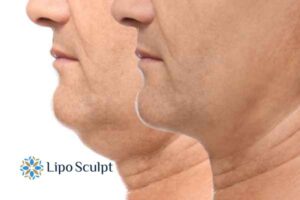 Double chin before and after Hi-Fu treatment 2 Double chin treatment England from Lipo Sculpt - feel more confident today!