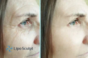How to Fight Aging Symptoms 2 Do you want to Fight Aging Symptoms England? Contact Lipo Sculpt today!