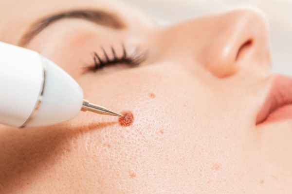 CryoPen: 5 Skin Concerns It May Be Used to Treat 3 What actually happens during a CryoPen treatment England?
