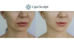 Explaining Total Skin Tightening Treatment And What It Can Do For You 2 Do you want to boost your self confidence? Give Morpheus8 England a try today!
