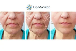 Explaining Total Skin Tightening Treatment And What It Can Do For You 3 Boost your confidence with Morpheus8 England call our team today!
