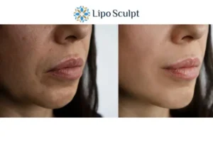 Explaining Total Skin Tightening Treatment And What It Can Do For You 4 Morpheus8 England the best results - call our team today!