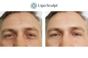 Explaining Total Skin Tightening Treatment And What It Can Do For You 6 Morpheus8 England book in today to find out more!