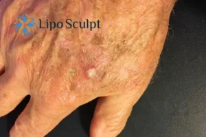 Best Actinic Keratoses Removal 2 Improve your wellbeing and health with Actinic Keratoses England removal.treatment