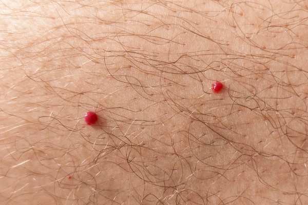 CryoPen: 5 Skin Concerns It May Be Used to Treat 2 cherry angioma removal England