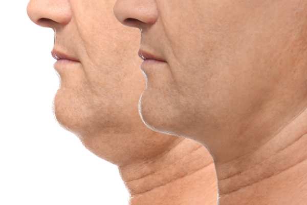Book your Chin Reduction Treatment England today!