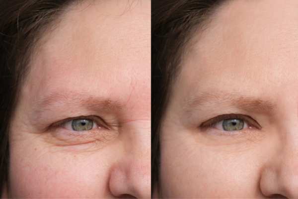 HIFU vs Botulinum Toxin: Understanding the Differences 4 How long do HIFU results last England?