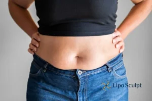 Bidding Farewell to Muffin Tops with Aqualyx Fat Injections 2 Do you wish you could reduce your muffin top England With Aqualy fat dissolving injections you can!
