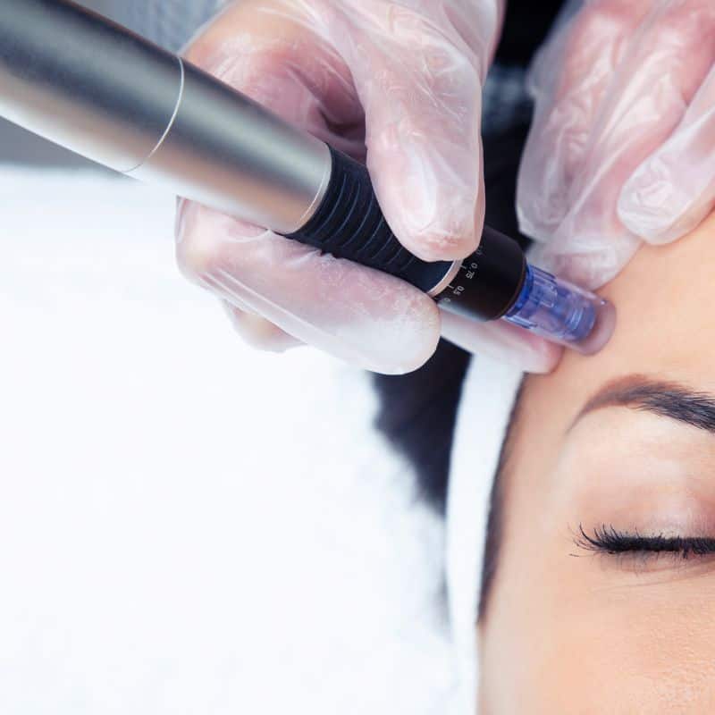 Morpheus8 treatment England from Lipo Sculpt - Book in today!