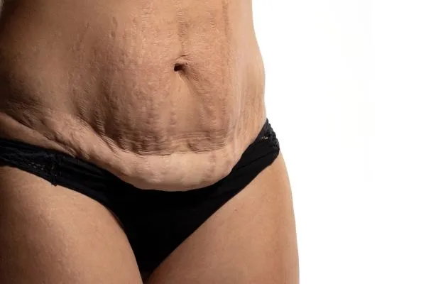 Lost the Weight but Not the Loose Skin? 1 image of womans stomach after weight loss showing loose skin England